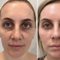 Understanding Recovery Times for Aesthetic Treatments in the UK