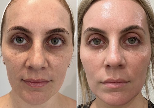 Understanding Recovery Times for Aesthetic Treatments in the UK